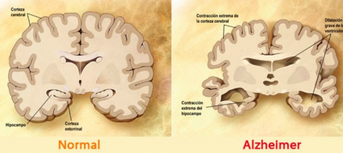 La enfermedad de Alzheimer